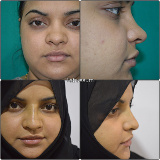 Nose Reshaping In Hyderabad Rhinoplasty Cost In Hyderabad & Secunderabad