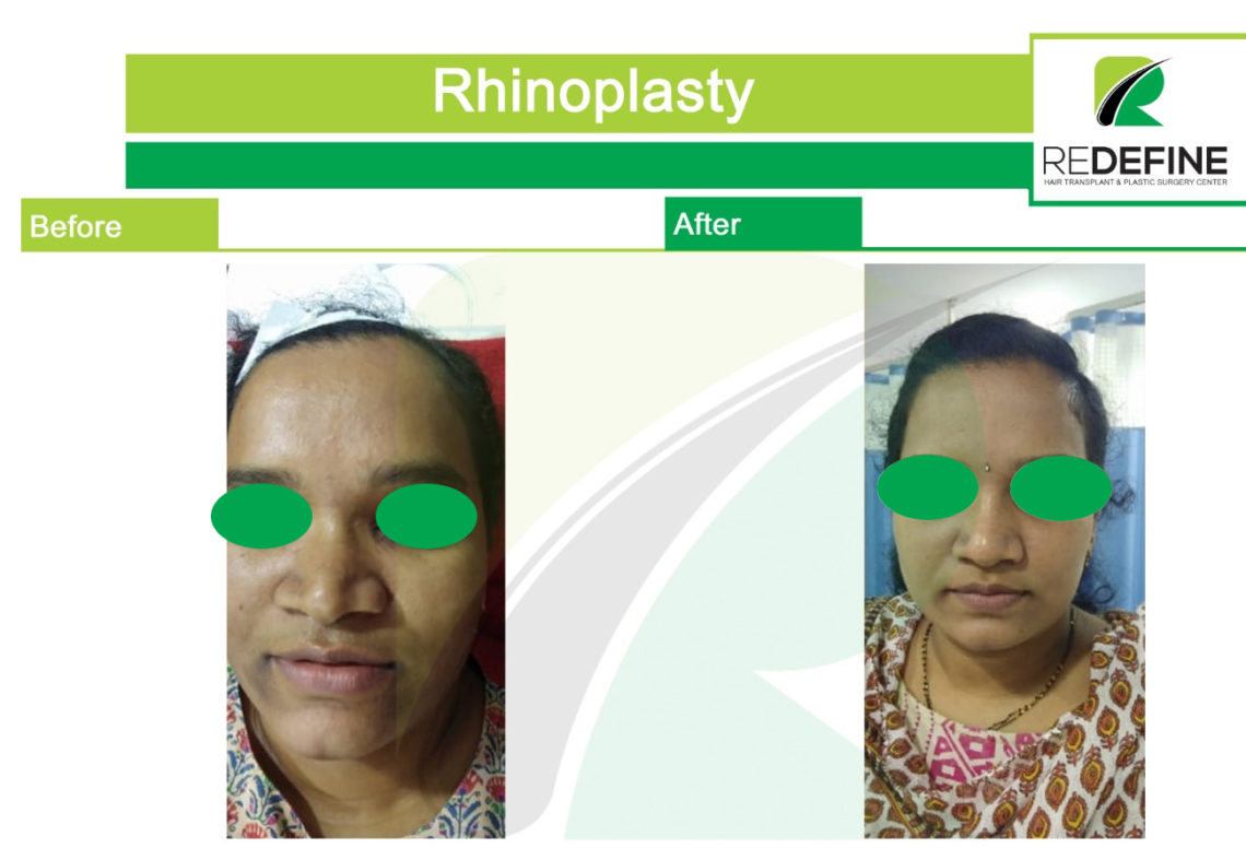 Nose Reshaping In Hyderabad Rhinoplasty Cost In Hyderabad & Secunderabad
